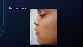 Nariz em sela
 