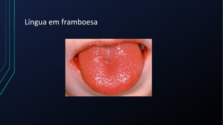 Língua em framboesa
 