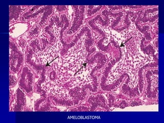 AMELOBLASTOMA
