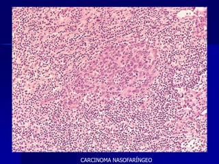 CARCINOMA NASOFARÍNGEO