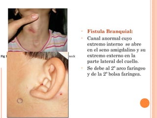 • Fistula Branquial:
• Canal anormal cuyo
extremo interno se abre
en el seno amigdalino y su
extremo externo en la
parte lateral del cuello.
• Se debe al 2º arco faríngeo
y de la 2º bolsa faríngea.
 