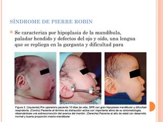 SÍNDROME DE PIERRE ROBIN
 Se caracteriza por hipoplasia de la mandíbula,
paladar hendido y defectos del ojo y oído, una lengua
que se repliega en la garganta y dificultad para
respirar.
 