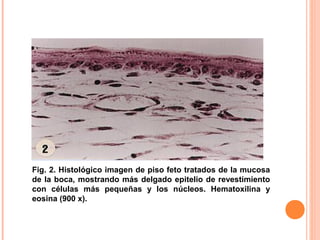  
Fig. 2. Histológico imagen de piso feto tratados de la mucosa
de la boca, mostrando más delgado epitelio de revestimiento
con células más pequeñas y los núcleos. Hematoxilina y
eosina (900 x).
 