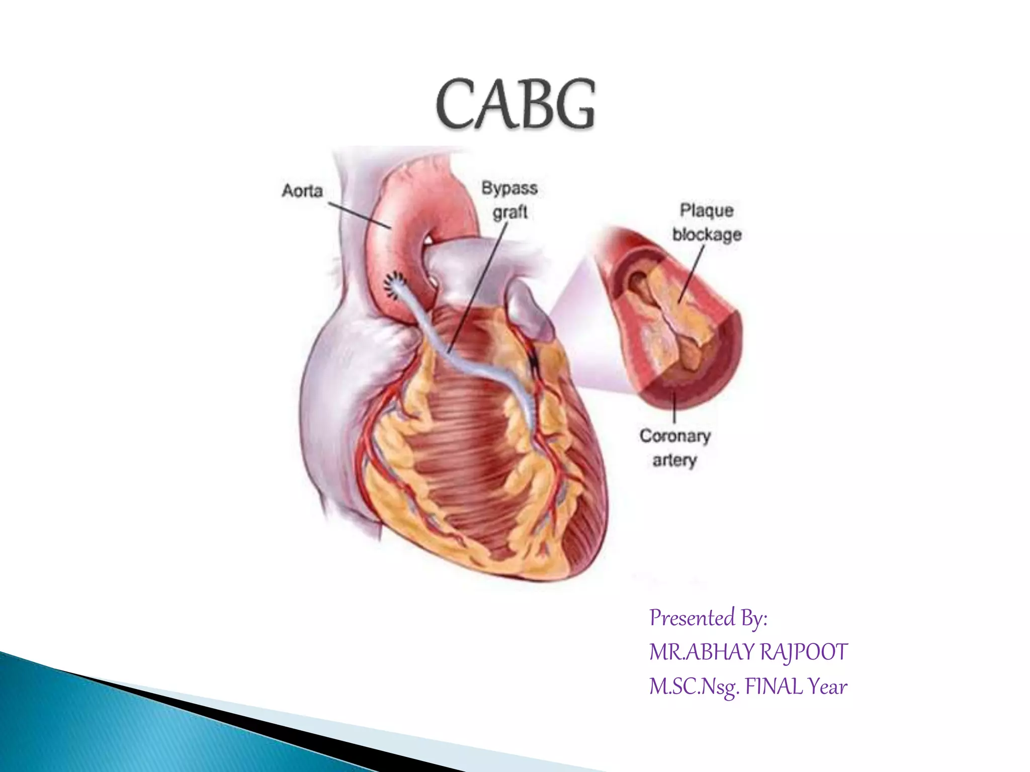 CABG | PPTX