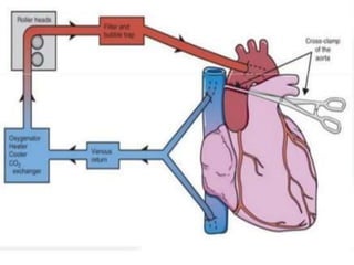 CABG | PPTX