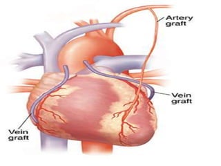 Vector Cabg CABG | PPTX