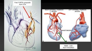 Free Y-RITA composite
from LITA
RIMA - LAD:
NOT FAVORED
 