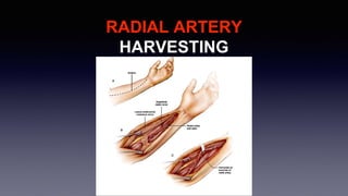 RADIAL ARTERY
HARVESTING
 