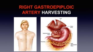 RIGHT GASTROEPIPLOIC
ARTERY HARVESTING
 