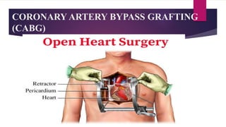 Vector Cabg CABG.pptx