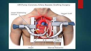 CABG | PPTX