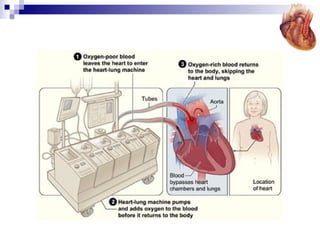 Cabg awam | PPT