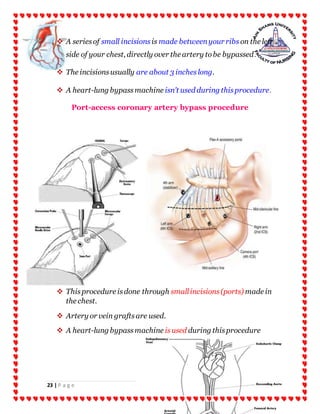 23 | P a g e
 A seriesof small incisions is made betweenyour ribs on the left
side of your chest, directly over the artery tobe bypassed.
 The incisionsusually are about 3 incheslong.
 A heart-lung bypassmachine isn't used during thisprocedure.
Port-access coronary artery bypass procedure
 Thisprocedure isdone through smallincisions(ports) made in
the chest.
 Artery or vein graftsare used.
 A heart-lung bypassmachine isused during thisprocedure
 