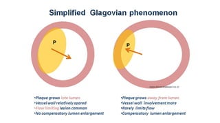 Coronary Artery Bypass Grafting (CABG) in Prior Percutaneous Coronary ...