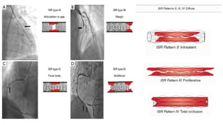 Coronary Artery Bypass Grafting (CABG) in Prior Percutaneous Coronary ...