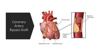 Cabg powerpoint | PPTX