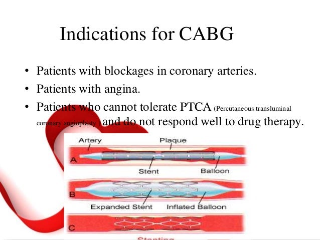 Cabg physical therapy exercises picture