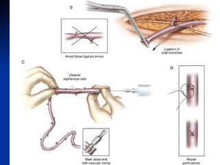 Quintuple Cabg Coronary artery bypass grafting (CABG) | PPT