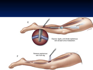 Coronary artery bypass grafting (CABG) | PPT
