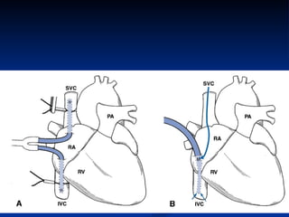 Quintuple Cabg Coronary artery bypass grafting (CABG) | PPT