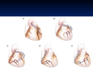 Quintuple Cabg Coronary artery bypass grafting (CABG) | PPT