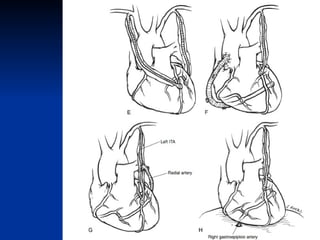 Quintuple Cabg Coronary artery bypass grafting (CABG) | PPT