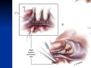 Coronary artery bypass grafting (CABG) | PPT