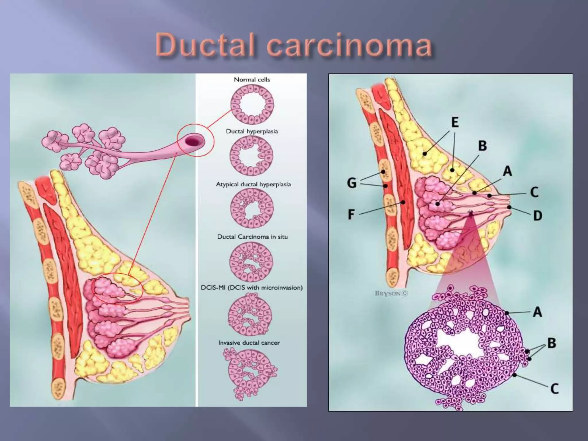 Ductal carcinoma