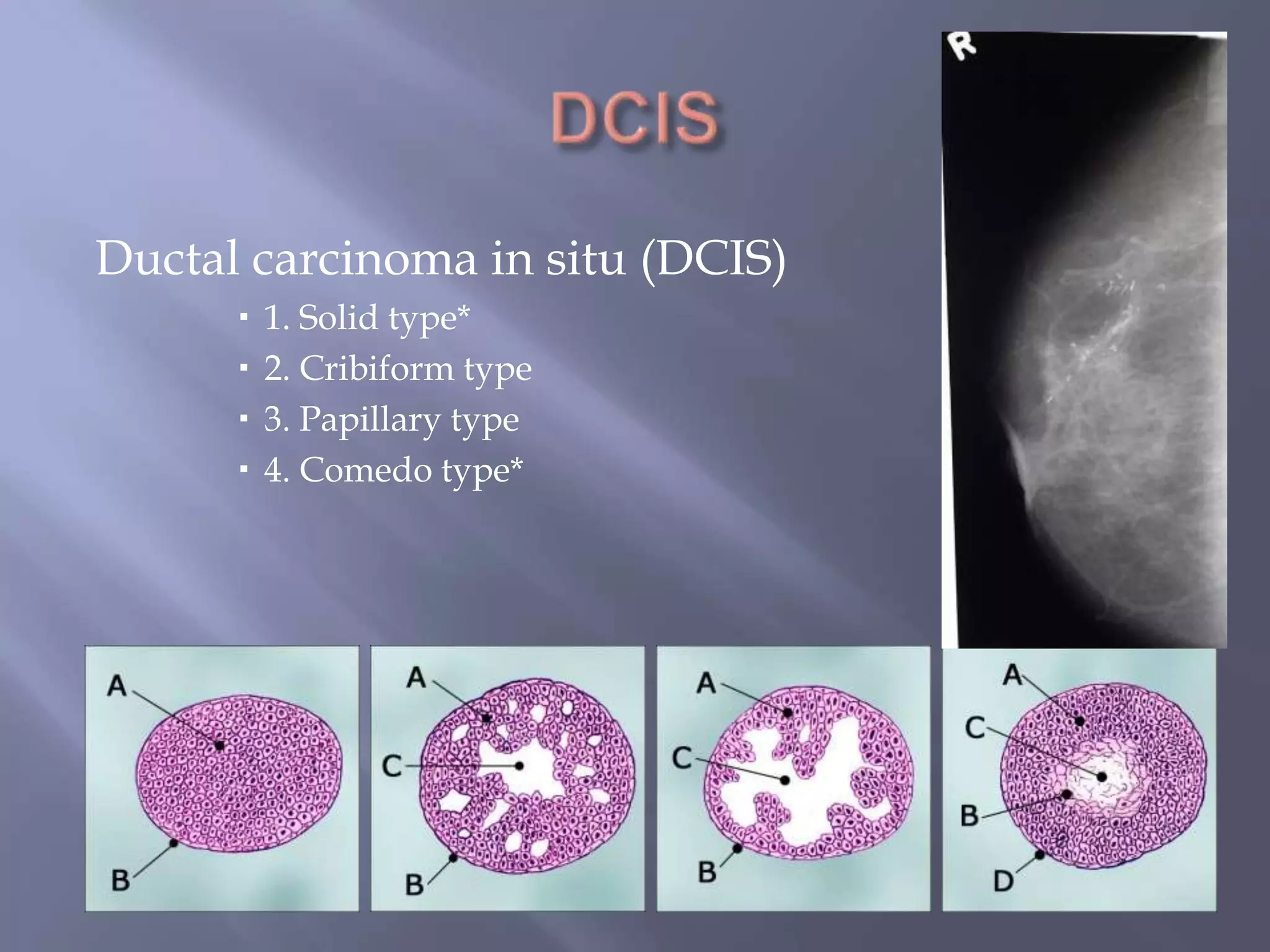 DCISDuctal carcinoma in situ (DCIS)1. Solid type*2. Cribiform type3. Papillary type4. Comedo type*