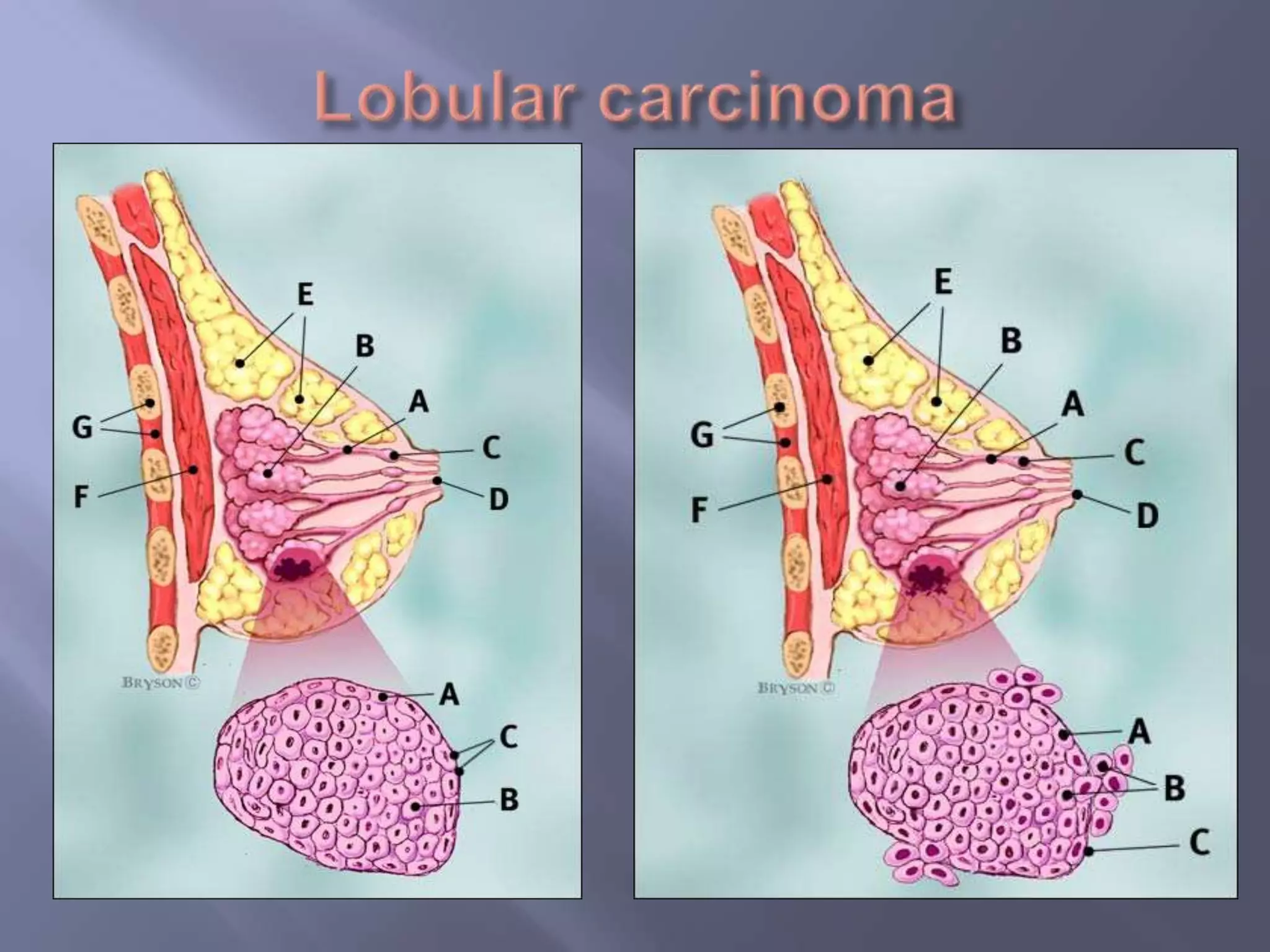 Lobular carcinoma