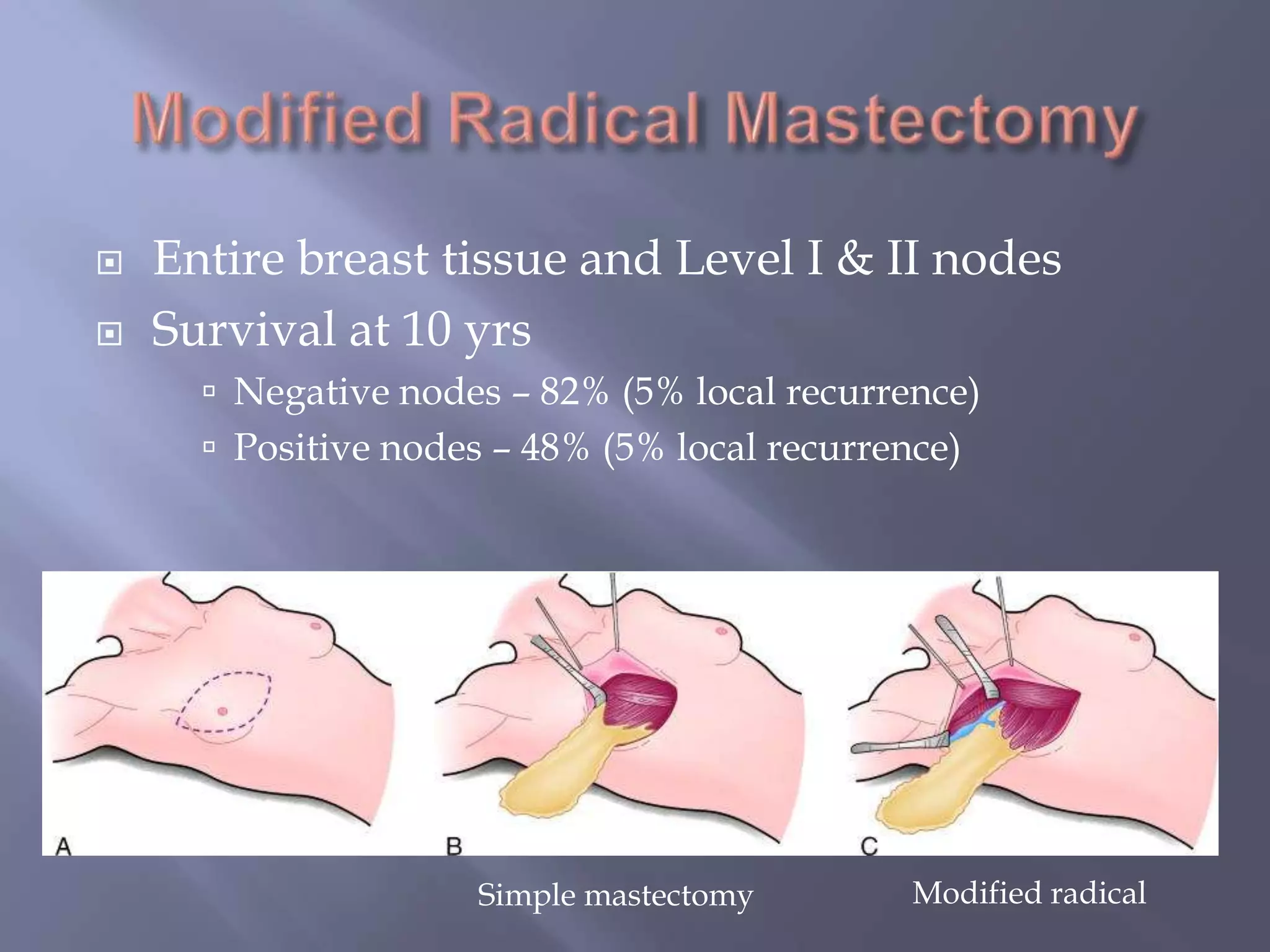 Modified Radical MastectomyEntire breast tissue and Level I & II nodesSurvival at 10 yrsNegative nodes – 82% (5% local recurrence)Positive nodes – 48% (5% local recurrence)Modified radicalSimple mastectomy