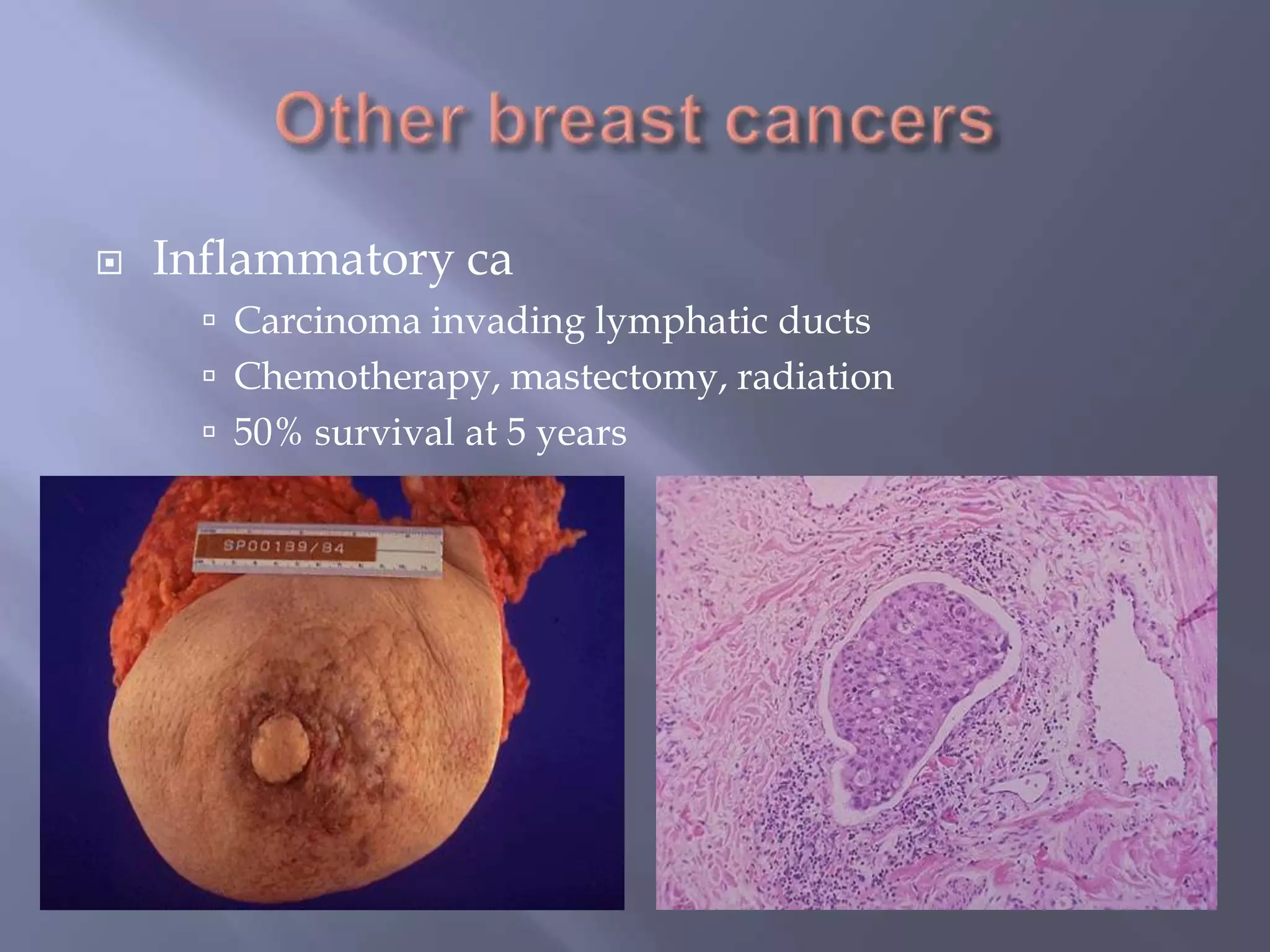 Other breast cancersInflammatory caCarcinoma invading lymphatic ductsChemotherapy, mastectomy, radiation50% survival at 5 years