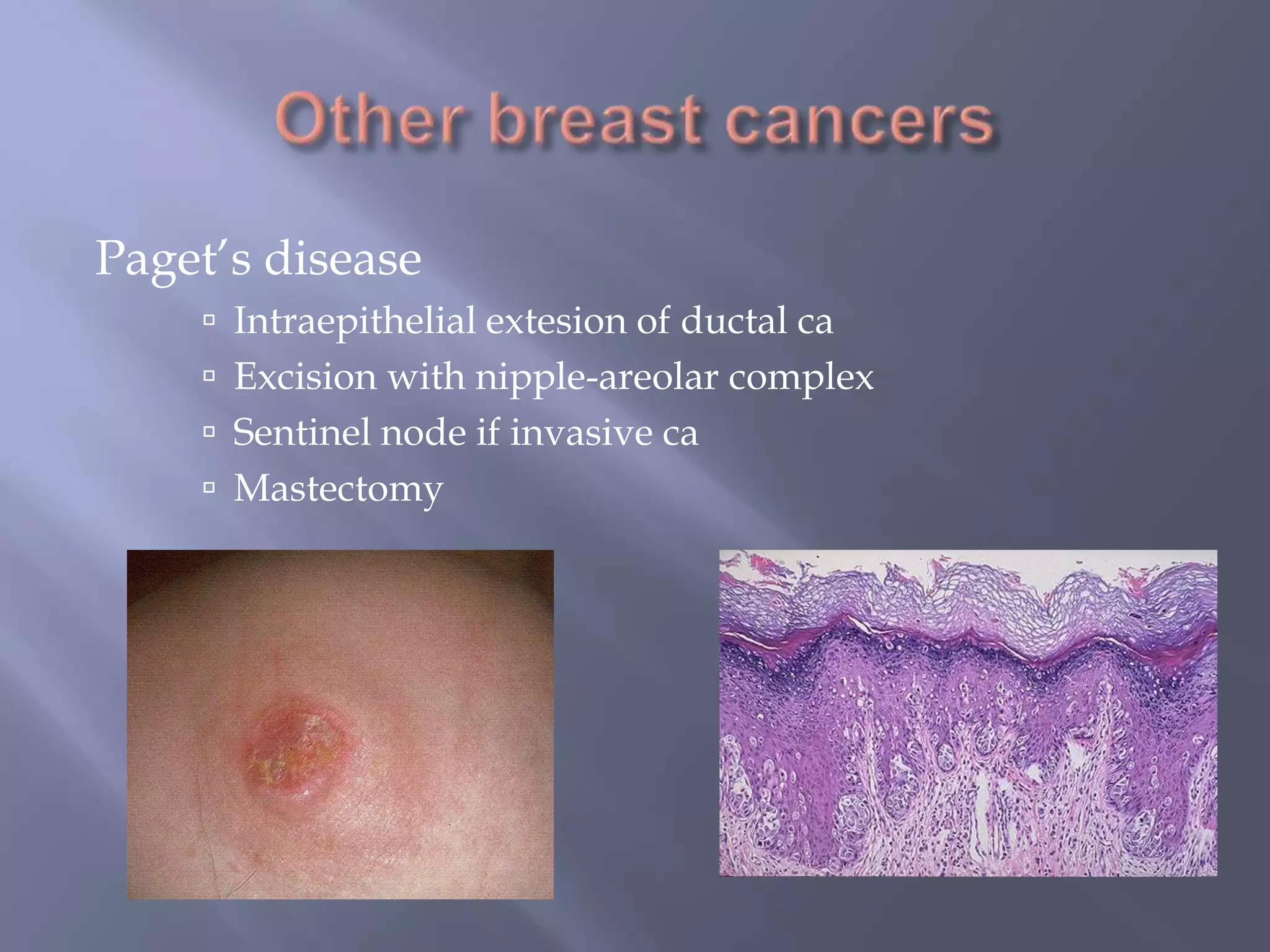 Other breast cancersPaget’s diseaseIntraepithelial extesion of ductal caExcision with nipple-areolar complexSentinel node if invasive caMastectomy