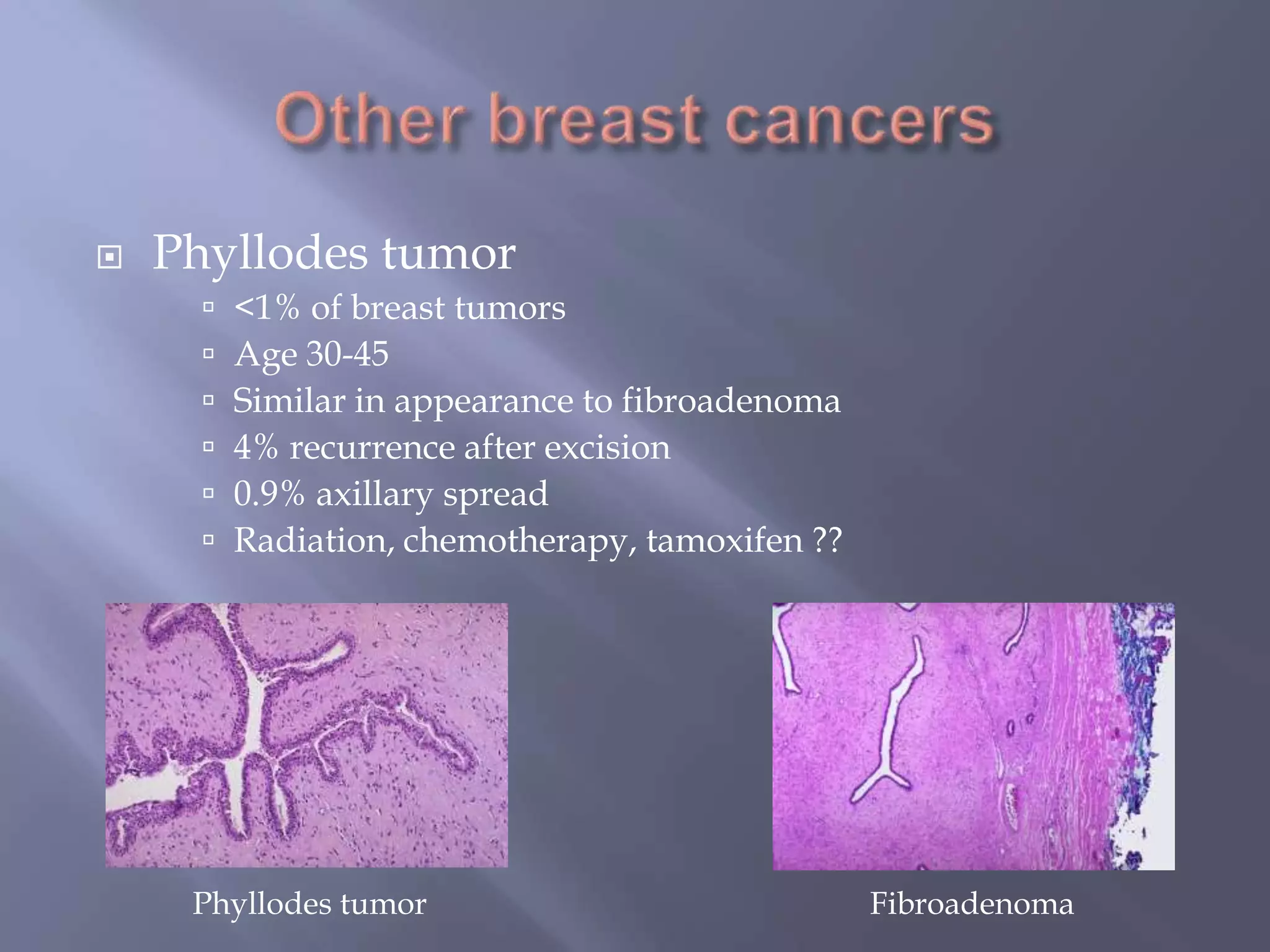 Other breast cancersPhyllodes tumor<1% of breast tumorsAge 30-45Similar in appearance to fibroadenoma4% recurrence after excision0.9% axillary spreadRadiation, chemotherapy, tamoxifen ??Phyllodes tumorFibroadenoma