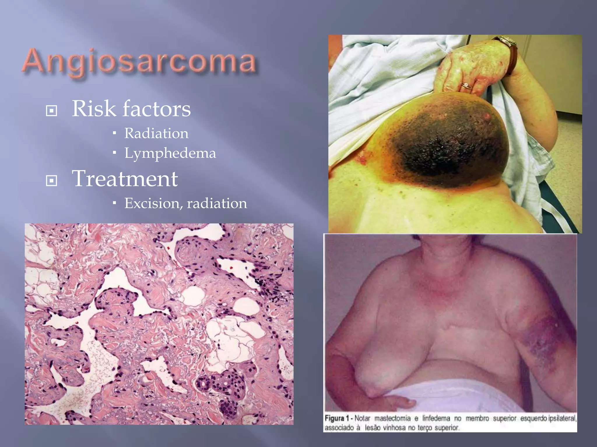 AngiosarcomaRisk factorsRadiationLymphedemaTreatmentExcision, radiation