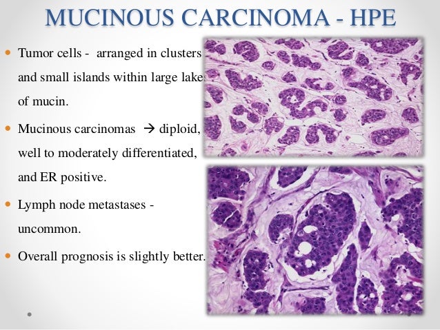 Ca breast molecular biology