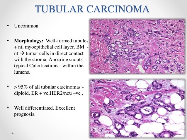 Ca Breast Molecular Biology