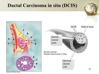 Ca breast management (according to NCCN guidelines) | PPTX
