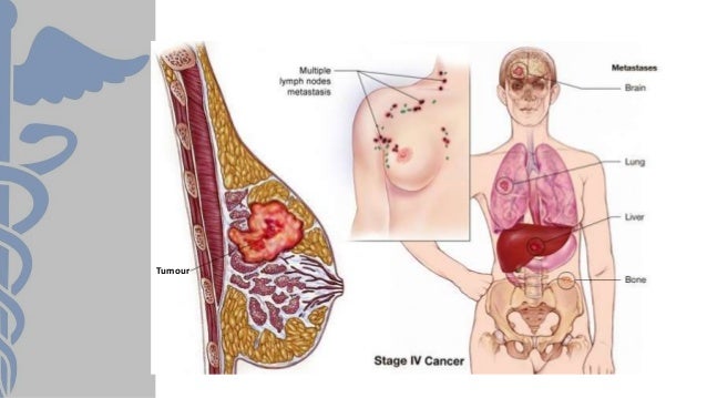 breast carcinoma metastasis
