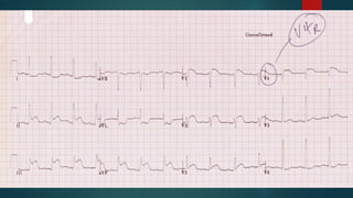 Breathing
Low tidal volumes
Modest fluid
resuscitation
Ventilation with Lower Tidal Volumes as Compared with Traditional Tidal
Volumes for ALI and the ARDS. N Enlg J Med. 2000; 342:1301-1308.
Comparison of Two Fluid-management Strategies in Acute Lung Injury. N
Enlg J Med. 2006 Jun;354(24):2564-75.
two
 