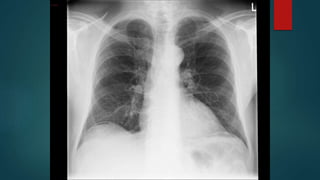 CirculationFluid choices
Conflicting evidence
Too much = bad lungs
Too little = reliance on vasopressors
African experience
Crystalloid or colloid
No starches
Mortality After Fluid Bolus in African Children with Severe Infection. N Engl J Med 2011;364:2483-2495.
A Comparison of Albumin and Saline for Fluid Resuscitation in the ICU. N Engl J Med. 2004 May;350(22):2247-
56.
Hydroxyethyl Starch 130/0.42 Versus Ringer’s Acetate in Severe Sepsis. N Engl J Med. 2012 Jul;367(2):124-
34.
Association of Hydroxyethyl Starch Administration with Mortality and Acute Kidney Injury in Critically Ill Patients
Requiring Volume Resuscitation: a Systematic Review and Meta-analysis. JAMA. 2013 Feb;309(7):678-88.
three
 