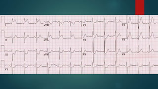 Source
control
Intervene within first 12
hours of diagnosis being
made
The least physiologically
insulting intervention
Surviving Sepsis Campaign: International Guidelines for Management of
Severe Sepsis and Septic Shock: 2012. Crit Care Med. 2013 Feb;41(2):580-
637.
five
 
