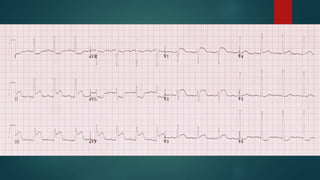 Antibiotics
(+ airway)
Broad
Culture
Avoid delay
De-escalate
Duration of Hypotension Before Initiation of Effective Antimicrobial Therapy is the
Critical Determinant of Survival in Human Septic Shock. CCM 2006 Jun;34(6):
1589-96
one
 
