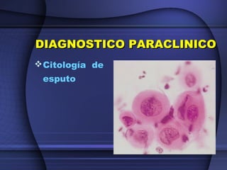 DIAGNOSTICO PARACLINICODIAGNOSTICO PARACLINICO
Citología de
esputo
 