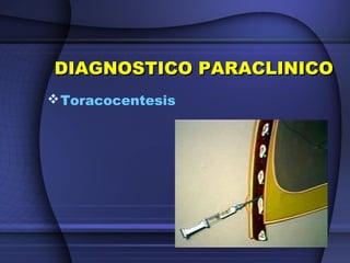 DIAGNOSTICO PARACLINICODIAGNOSTICO PARACLINICO
Toracocentesis
 