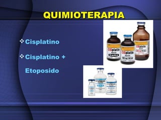 QUIMIOTERAPIAQUIMIOTERAPIA
Cisplatino
Cisplatino +
Etoposido
 