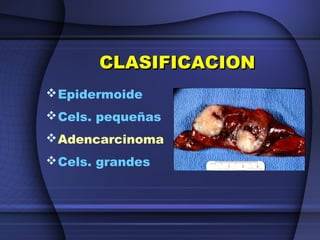 CLASIFICACIONCLASIFICACION
Epidermoide
Cels. pequeñas
Adencarcinoma
Cels. grandes
 