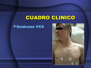 CUADRO CLINICOCUADRO CLINICO
Síndrome VCS
 