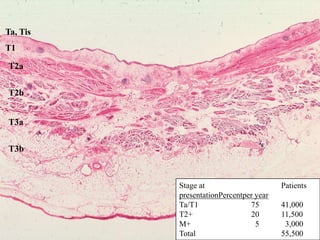 Ta, TisT1T2aT2bT3aT3bStage at			   PatientspresentationPercentper yearTa/T1		    75	   41,000T2+		    20	   11,500M+		      5	     3,000Total			   55,500