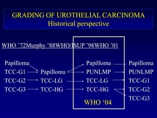 GRADING OF UROTHELIAL CARCINOMAHistorical perspectiveWHO ’72Murphy ’88WHO/ISUP ’98WHO ’01  Papilloma	  			    Papilloma		 Papilloma  TCC-G1	     Papilloma	    PUNLMP	   	 PUNLMP  TCC-G2	     TCC-LG		    TCC-LG		 TCC-G1  TCC-G3	     TCC-HG		    TCC-HG		 TCC-G2								 TCC-G3WHO ‘04